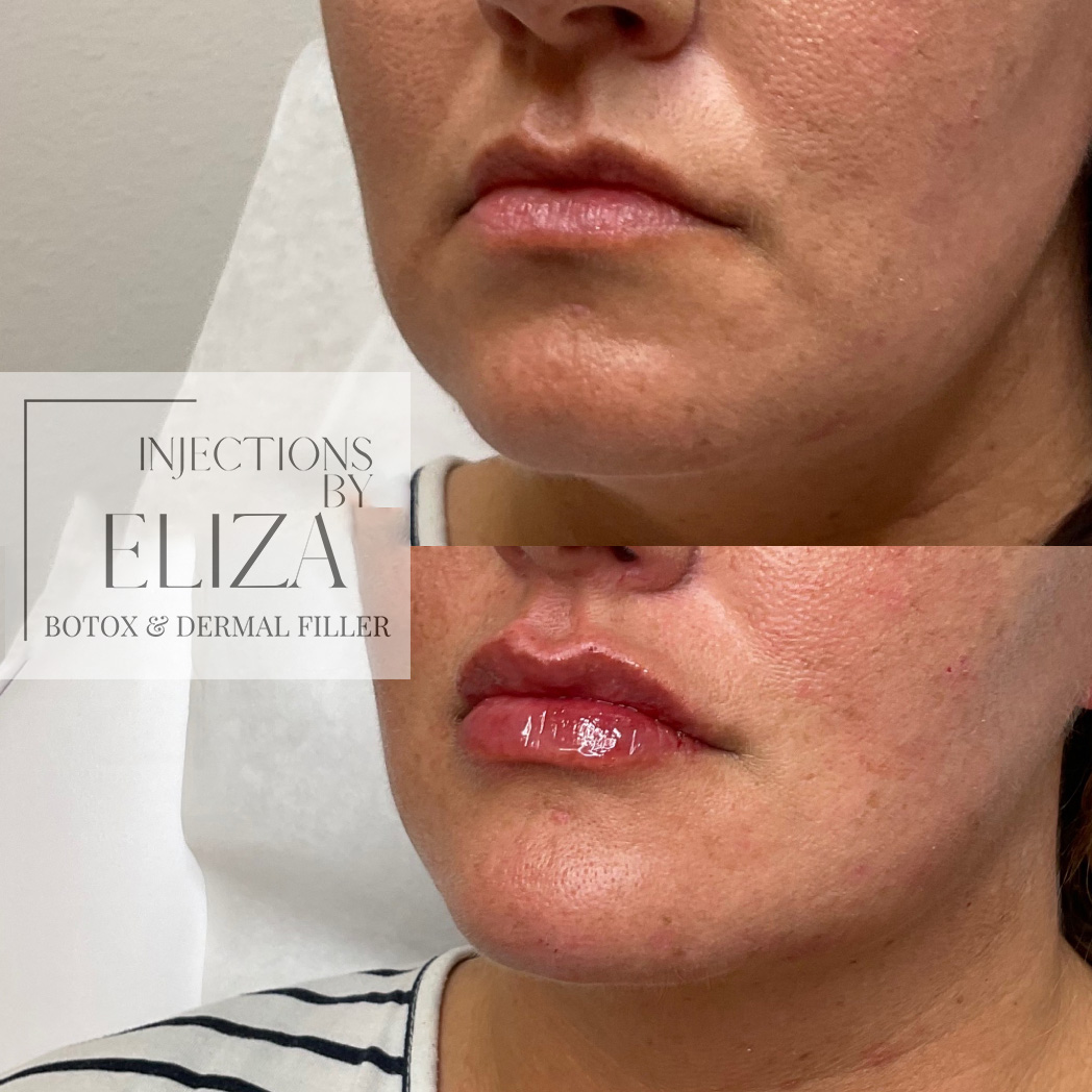 Lip Filler and Chin Filler