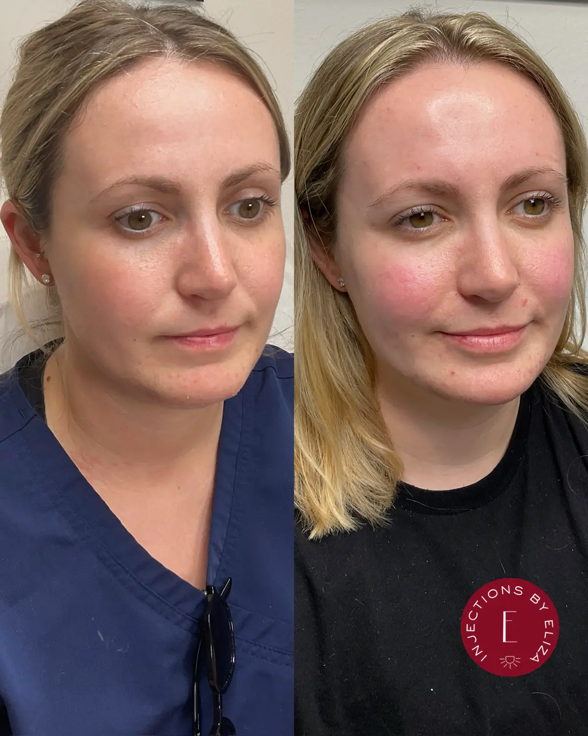 Facial filler- chin,