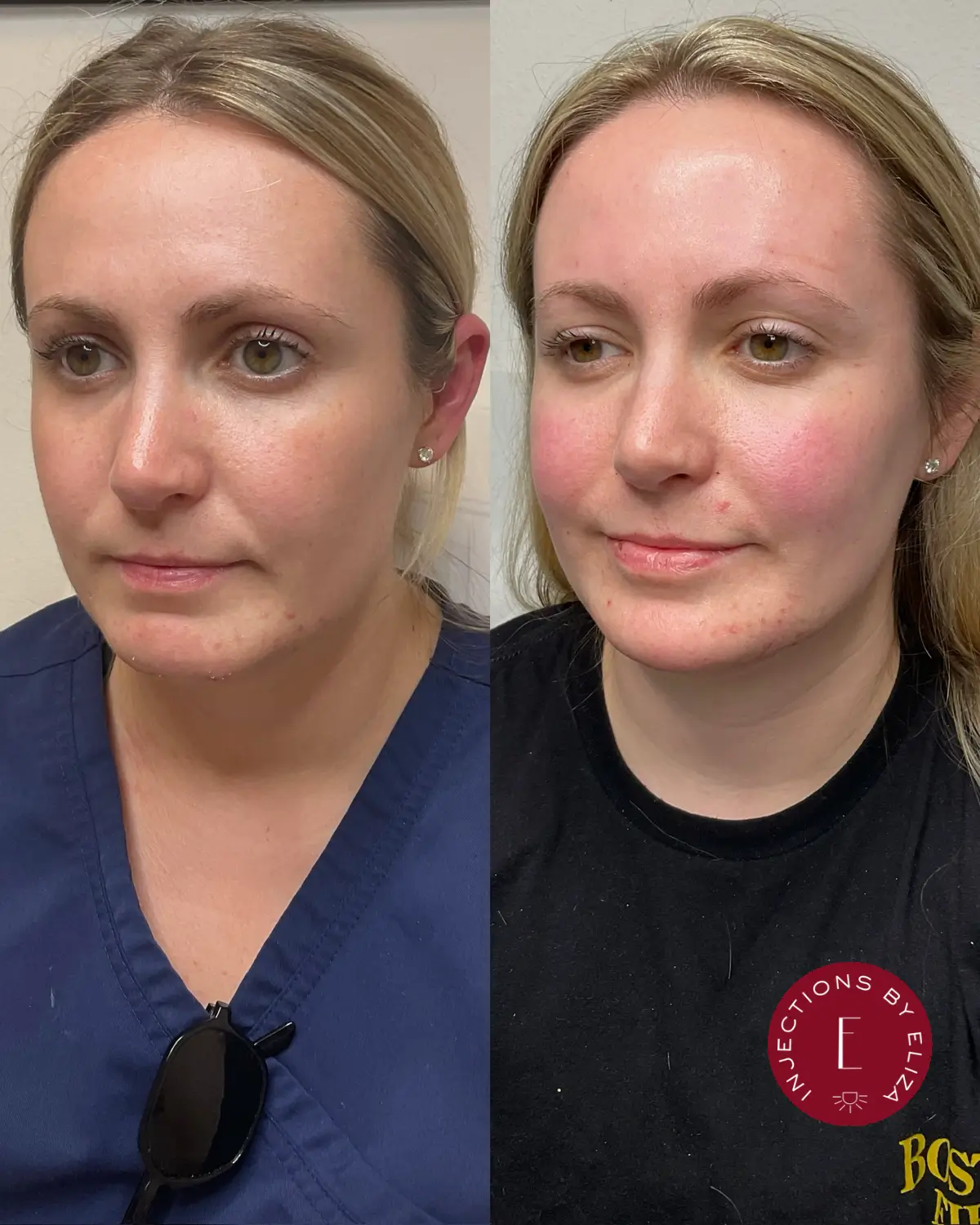 Facial filler- chin, 2