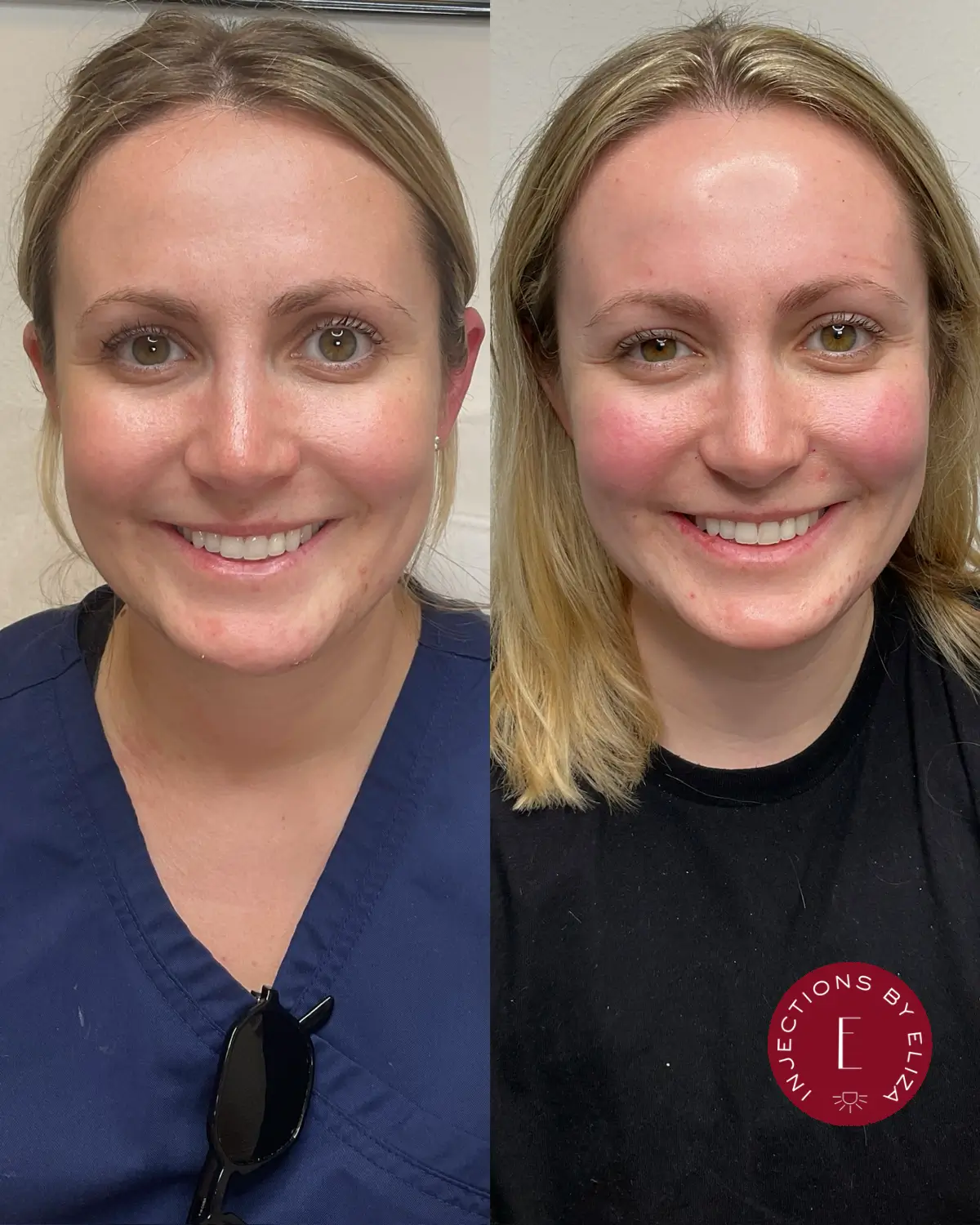 Facial filler- chin, 2