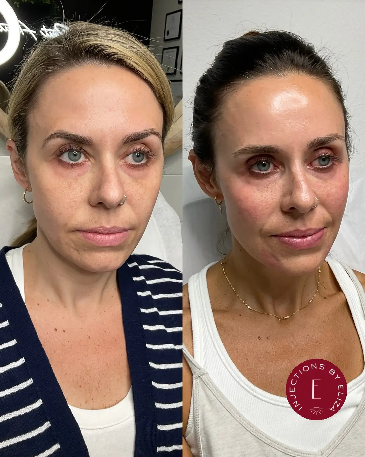 Facial harmonization, 2