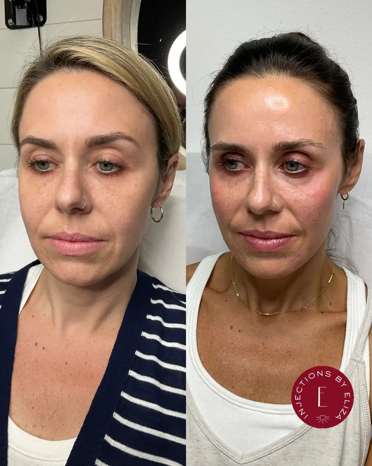 Facial harmonization,3