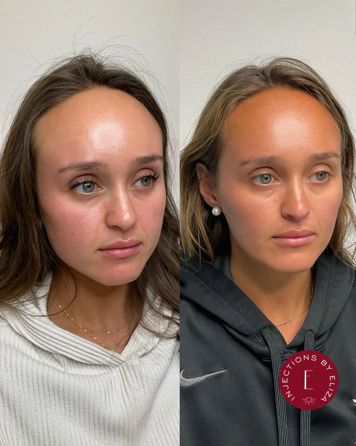 Upper face dysport 2