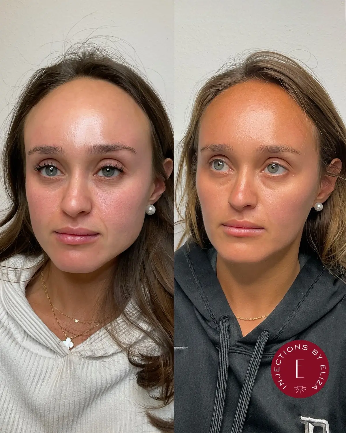 Upper face dysport 3